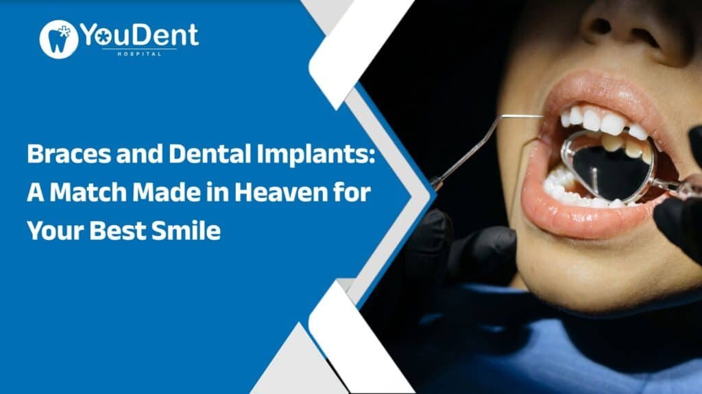Braces and Dental Implants