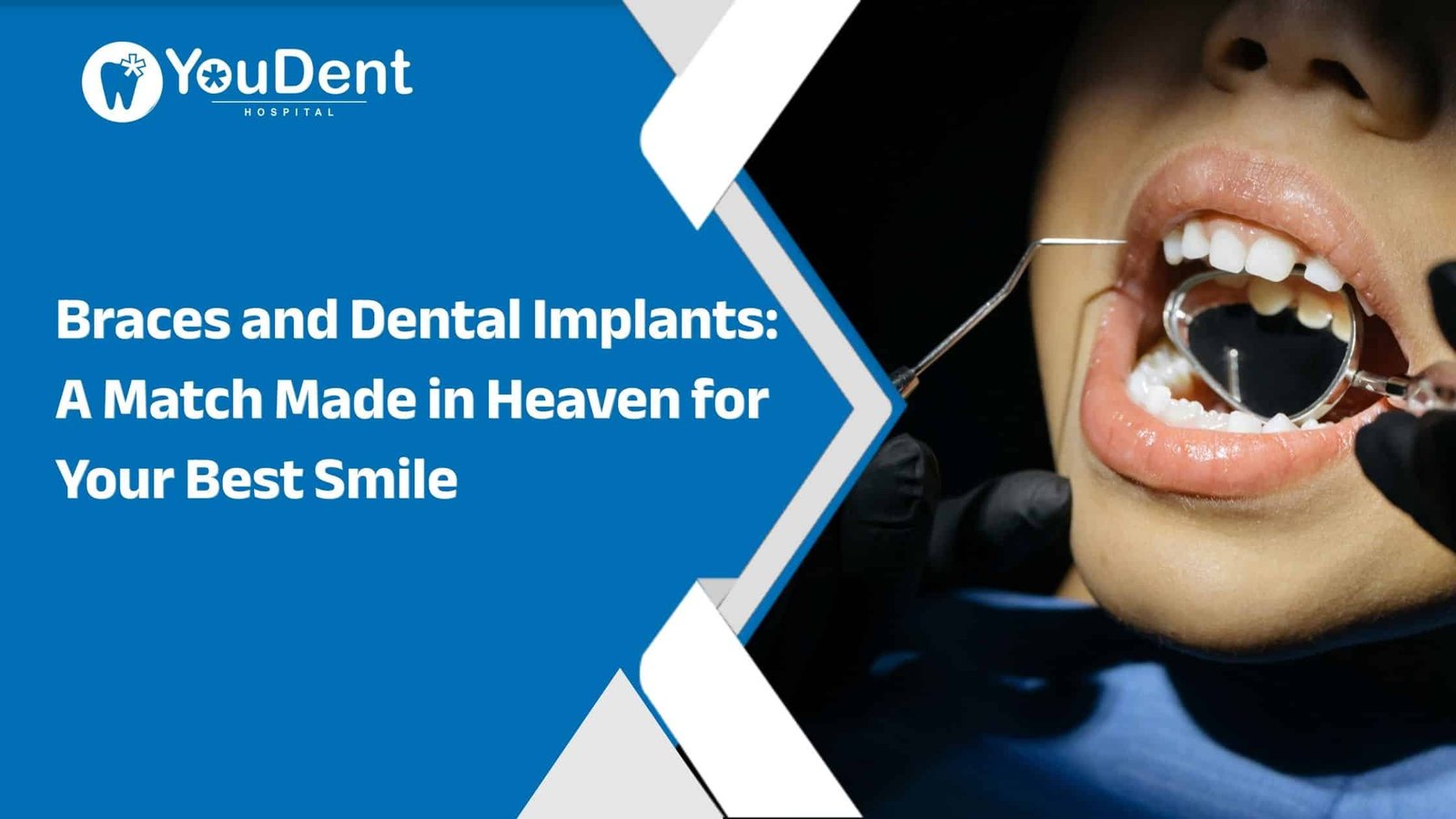 Braces and Dental Implants