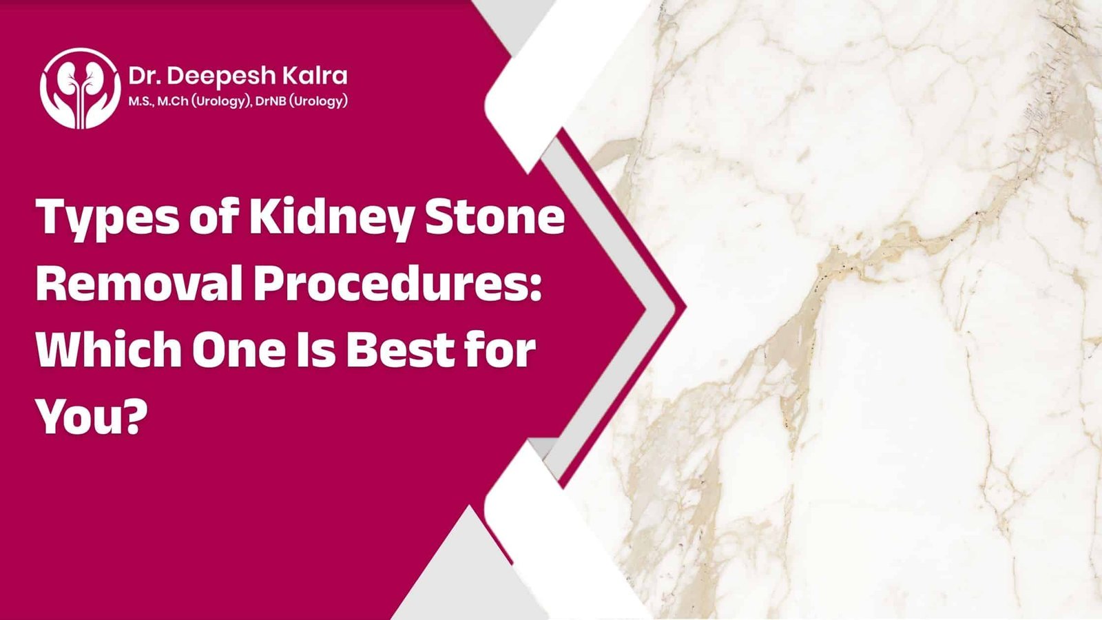 Types of Kidney Stone Removal Procedures Which One Is Best for You